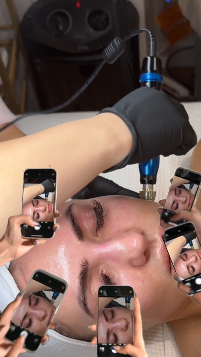 Microagulhamento