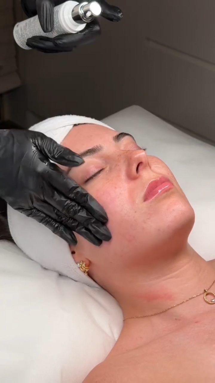 microneedling