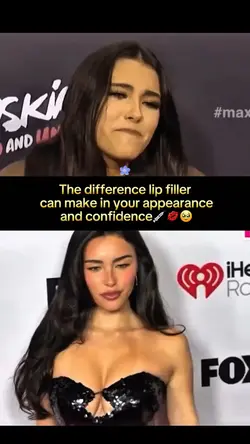Lips Before After