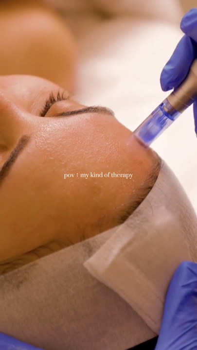 Microneedling 