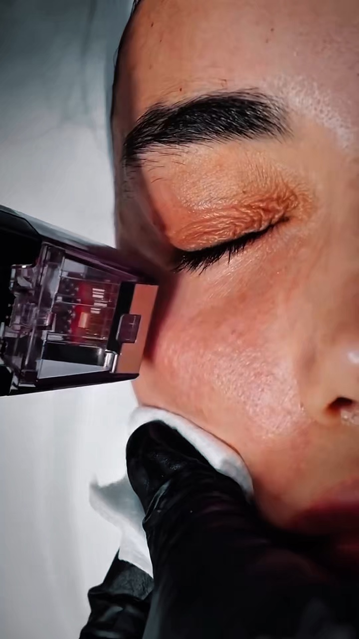 Microneedling aesthe