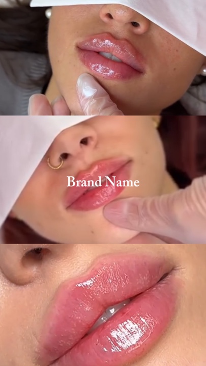 Relleno de labios