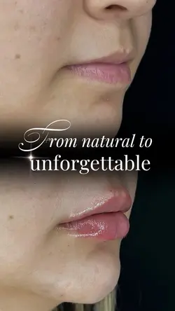 Lip Filler
