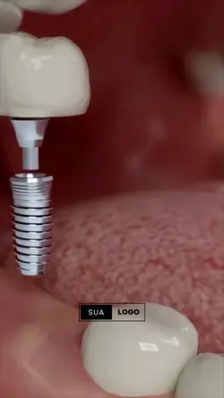 Implante Dental 