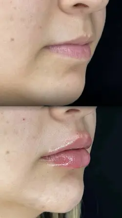 Preenchimento labial