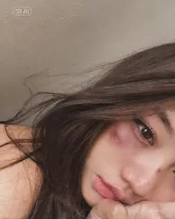 bruises on the face