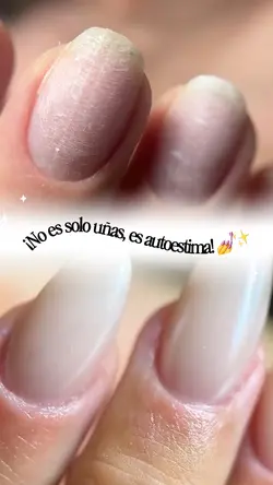Antes Y después Uñas