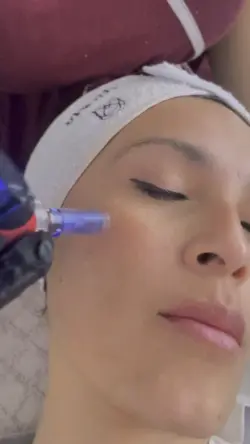 Microneedling
