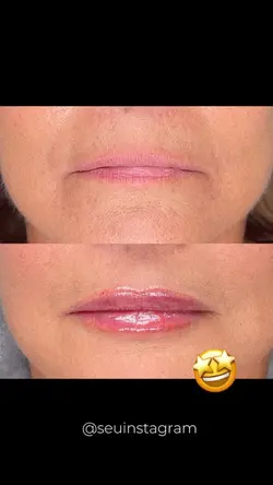 Preenchimento LABIAL