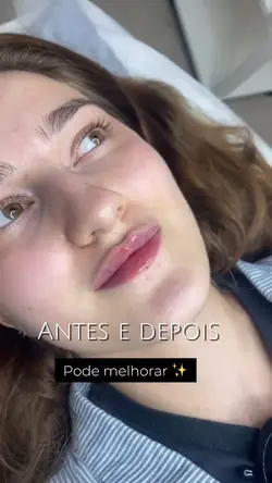 Antes e Depois Lábio