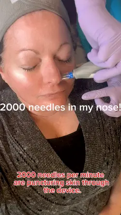 Microneedling 