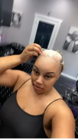 Alopecia 