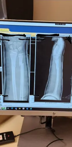 broken arm