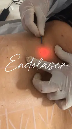Endolaser