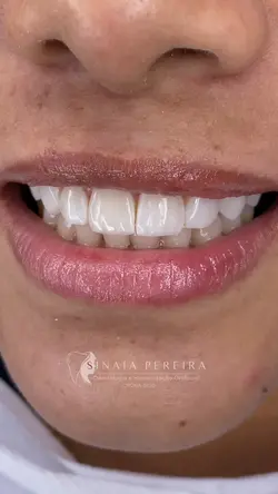 Antes e depois