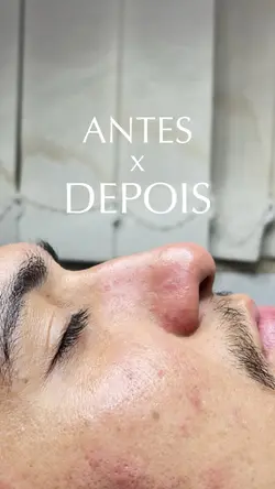 Antes e Depois Story