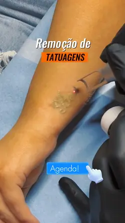 Remoção de Tatuagens