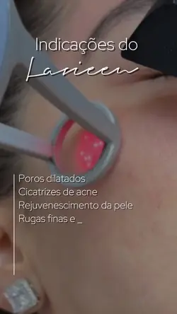 Laser lavieen 