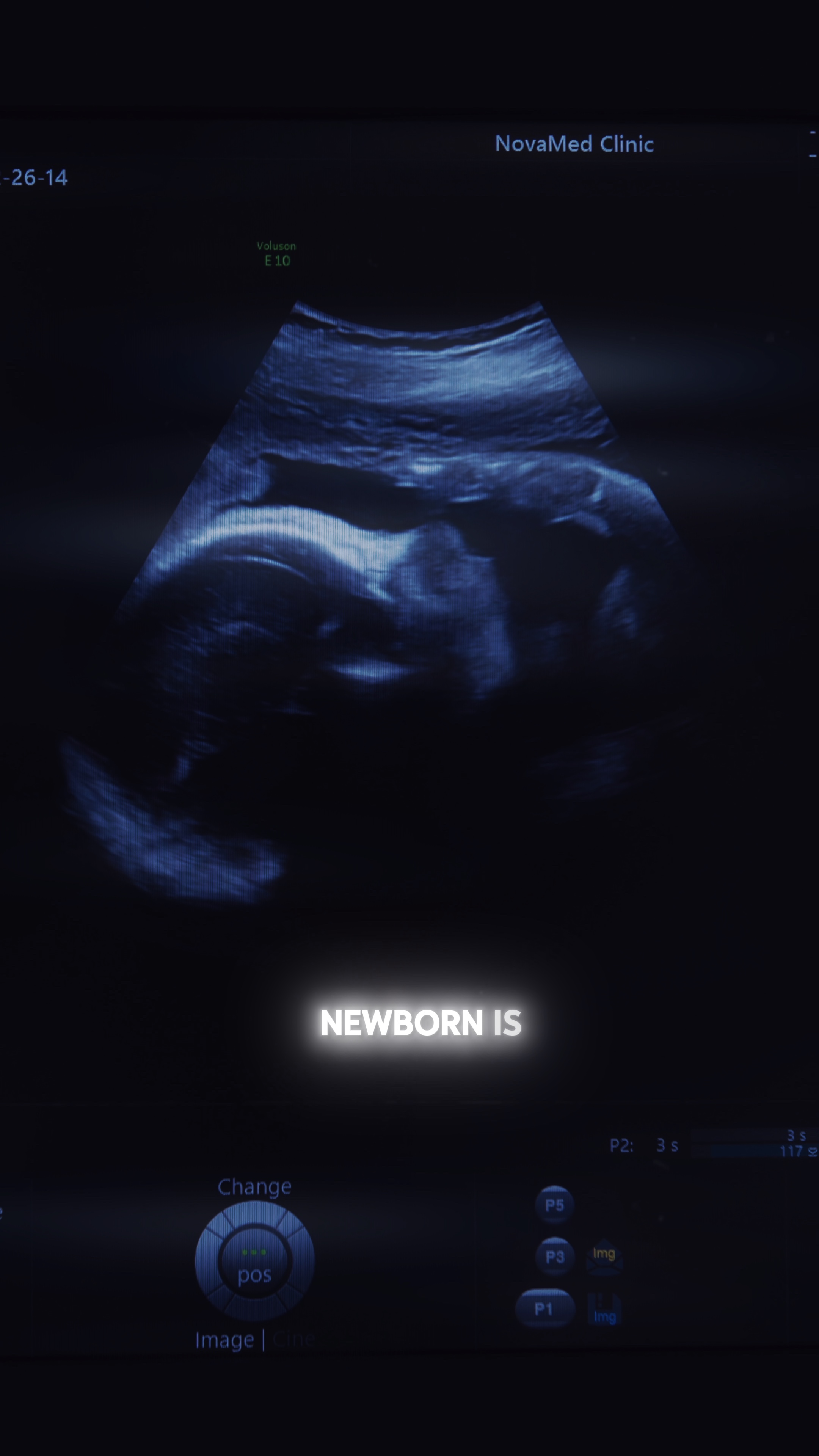 Waiting Newborn