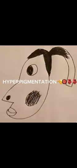 HYPERPIGMENTATION๐ฅด๐ฅด