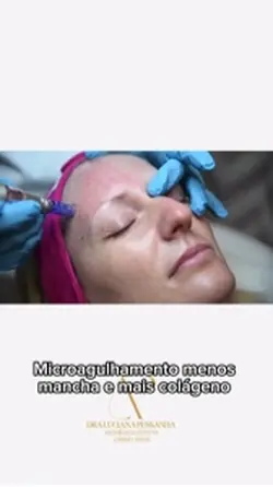 Microagulhamento 