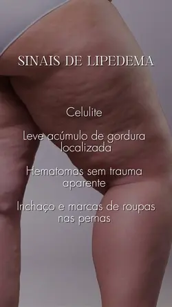 Lipedema 