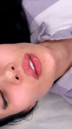 Preenchimento labial