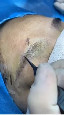 Eyebrow transplantat
