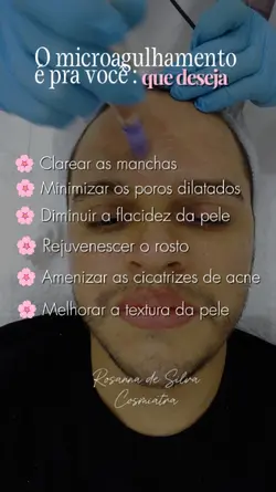 Microagulhamento