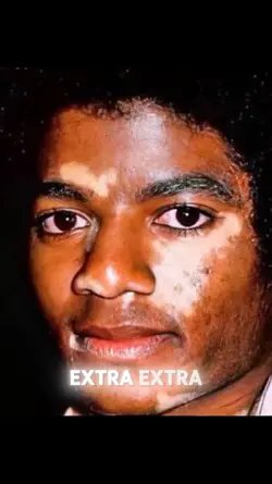 MJs vitiligo